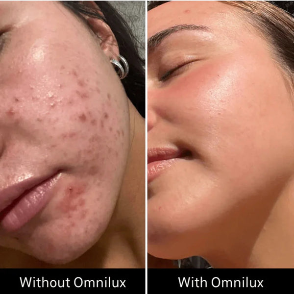 Omnilux Clear LED Face Mask